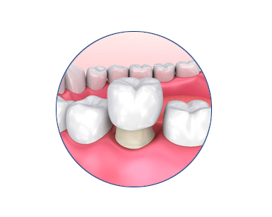 crowns-dentist-in-carrollwood-wesley-chapel