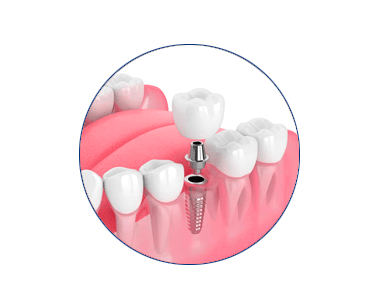 dental-implants-in-carrollwood-wesley-chapel